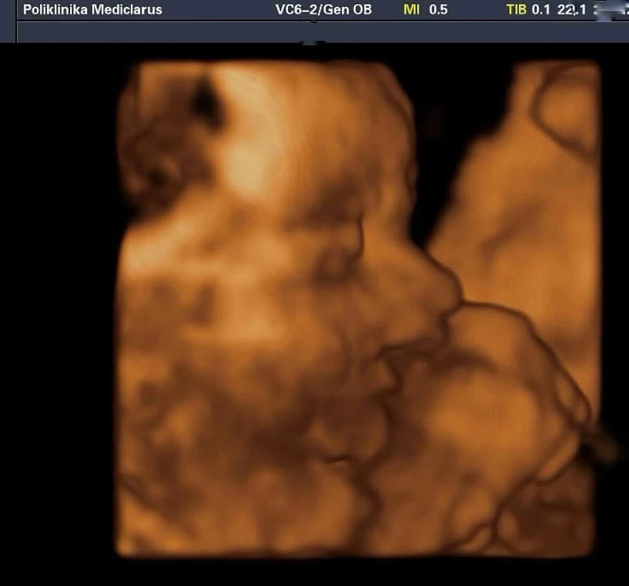 Zavirite u svijet svoje bebe uz najsuvremeniji 4D ultrazvuk - Poliklinika Mediclarus